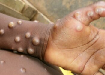 KIWON LAFIYA: Me cece cutar Monkey pox, alamun kamuwa da cutar, hanyoyin da za a kiyaye don gujewa kamuwa da cutar